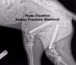 PLATE FIXATION FEMUR BILATERAL