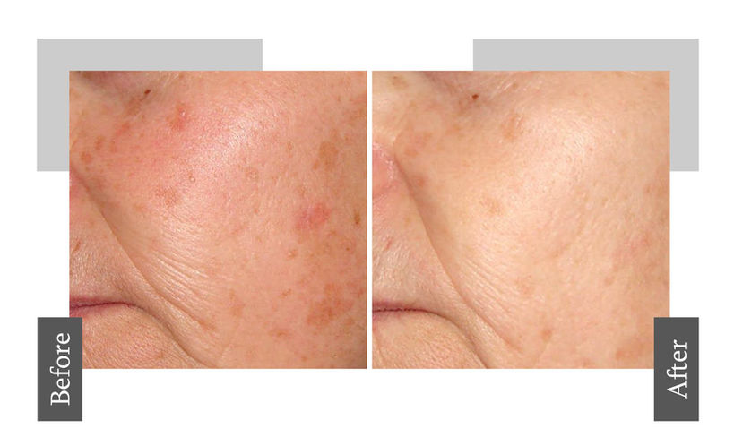 удаление пигментных пятен в киеве, цена и отзывы.jpg