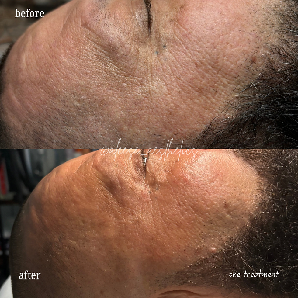 after 1 treatment of microchanneling
