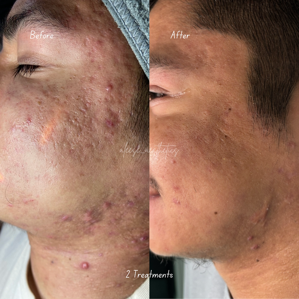 Mirochanneling Treatment