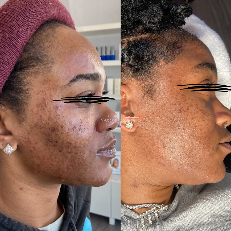 2 Microchanneling Treatments