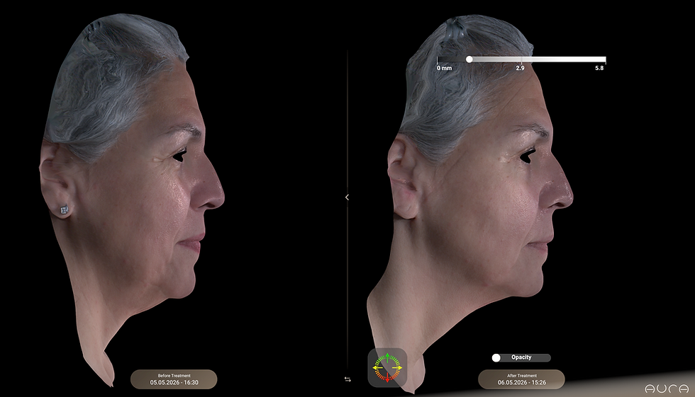 XERF skin tightening before and after at Hydr8 Med Spa Houston showing improved jawline definition and firmer skin after treatment