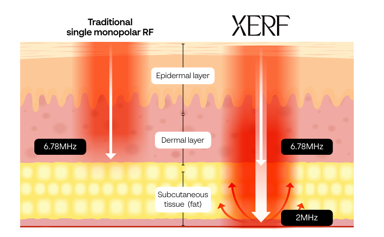 XERF skin tightening diagram showing dual frequency technology targeting deeper layers of skin to improve collagen and reduce Ozempic face after weight loss