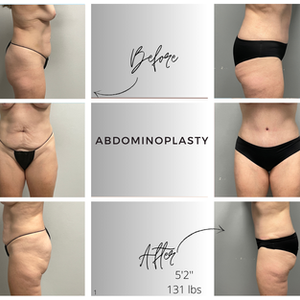 Abdominoplasty