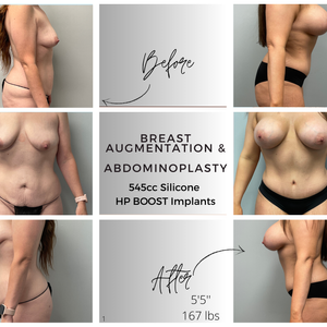 Breast Augmentation & Abdominoplasty 