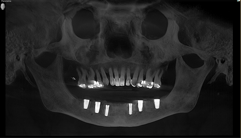 KB_post op CBCT Lower