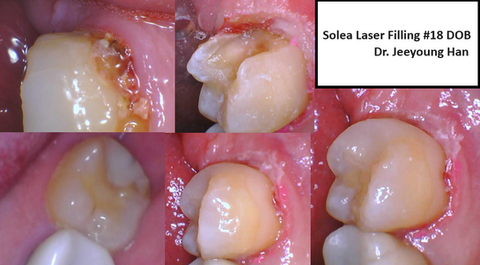 Solea laser #18 class2 and 5 wrap around filling