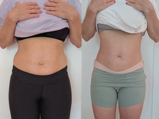 Rektusdiastase schließen – Vorher/Nachher: Veränderungen, die weit über den Bauch hinausgehen