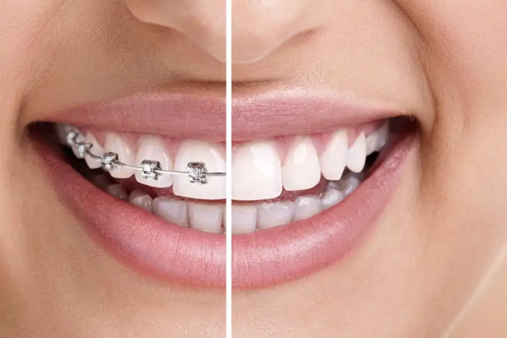 dentisaude-medicina-dentaria-tratamentos-ortodontia.webp