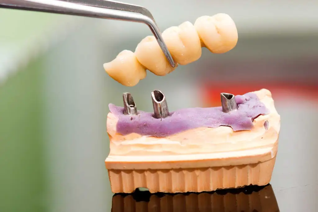 dentisaude-medicina-dentaria-tratamentos-coroas-dentarias.webp