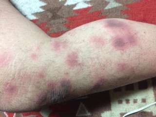 Nummular Eczema - Itchy coin-shaped spots