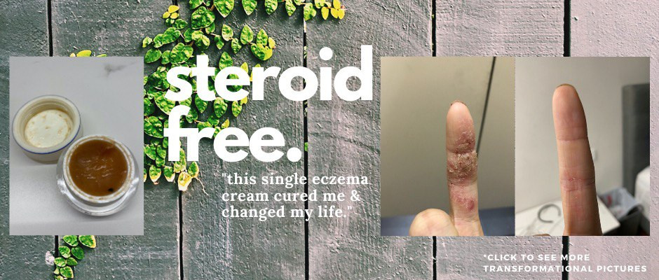 This Single Eczema Cream Cured Me & Changed My Life (Steroid-Free)