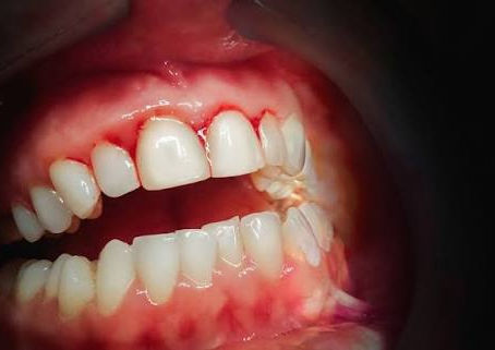 Why Do Gums Bleed Even When Teeth Look Normal?