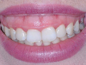 Title: "Regain Confidence and Show off Your Best Smile: Gummy Smile Treatment at Kiran Dental Clinic