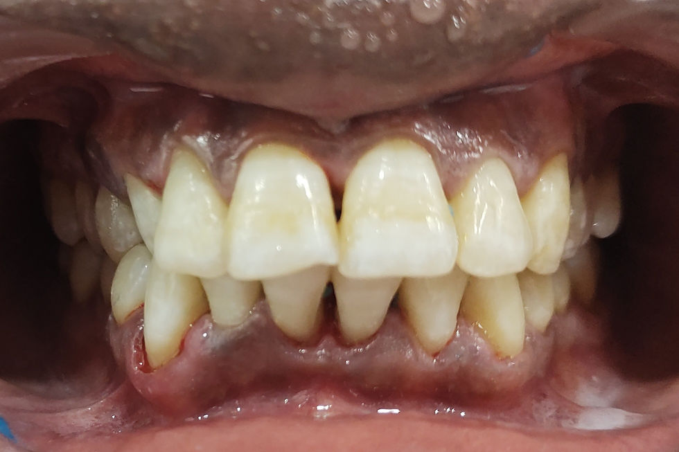 Caption: "Transform your smile with safe and professional teeth whitening at Kiran Dental Clinic, Vizianagaram! Say goodbye to fluorosis stains with our expert cosmetic dentistry. #TeethWhitening #CosmeticDentistry #Vizianagaram"
Alt text: "After teeth whitening result on severe fluorosis-affected teeth at Kiran Dental Clinic, Vizianagaram. Achieve a brighter smile with our professional cosmetic dentistry services! #TeethWhitening #CosmeticDentistry #Vizianagaram"