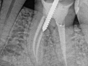 Why Is a Metal Threaded Post Placed After Root Canal Treatment? A Complete Guide to Post and Core Restoration