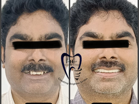 🦷 Full Mouth Rehabilitation: From Painful Teeth to Confident Smiles at Kiran Dental Clinic, Vizianagaram