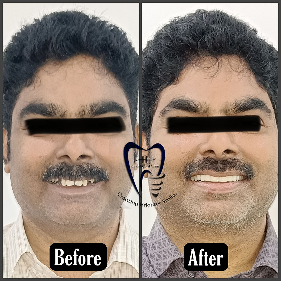 Before and after full mouth rehabilitation with zirconia crowns and gum treatment at Kiran Dental Clinic Vizianagaram