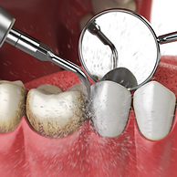 Professional periodontist conducting deep cleaning procedure on a patient's teeth at Kiran Dental Clinic in Vizianagaram. Dr. Priyanka Majji, leading expert in gum disease treatment, performs scaling and root planing to remove plaque and tartar buildup, promoting optimal oral health. Schedule your appointment for comprehensive dental care today."