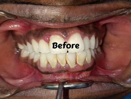 🌟 Brighten Yellow Teeth with a Simple Dental Cleaning at Kiran Dental Clinic Vizianagaram