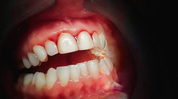 Do Bleeding Gums Need Antibiotics? A Periodontist’s Perspective