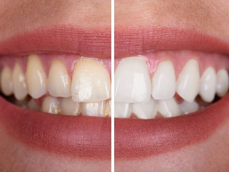 Unveiling a Dazzling Smile: Teeth Whitening Solutions at Kiran Dental Clinic in Vizianagaram