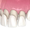"Porcelain dental veneer being carefully placed on a tooth by a dentist at Kiran Dental Clinic in Vizianagaram, India. The dentist ensures a precise fit and natural appearance, enhancing the patient's smile. Dental veneers at Kiran Dental Clinic are crafted with high-quality materials for long-lasting results and are tailored to each patient's unique needs and preferences."