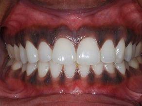 "Brighten Your Smile: Black Gums Treatment at Kiran Dental Clinic, Vizianagaram by Periodontist
