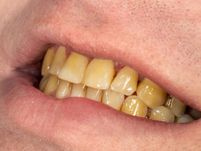 Unveiling a Dazzling Smile: Teeth Whitening Solutions at Kiran Dental Clinic in Vizianagaram