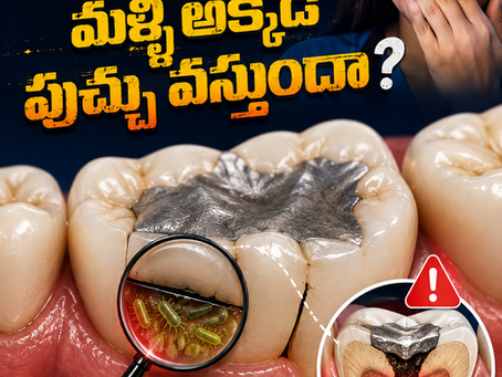 Can a Tooth Decay Again Under an Old Filling? Understanding Recurrent or Secondary Caries