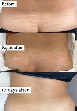 Art PM Chicago Inkless Stretch Mark Revision