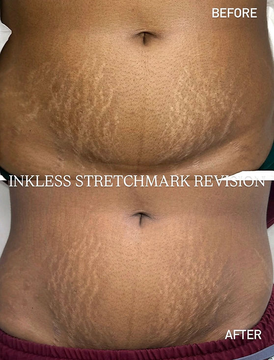 Stomach inkless stretch marks revision