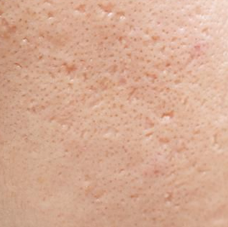 acne scars