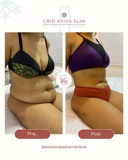 Harmonização Corporal