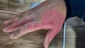 Tratamento de Queimaduras com Laserterapia e Curativos