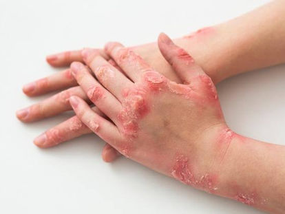 Como acelerar a cicatrização de queimaduras com Laserterapia