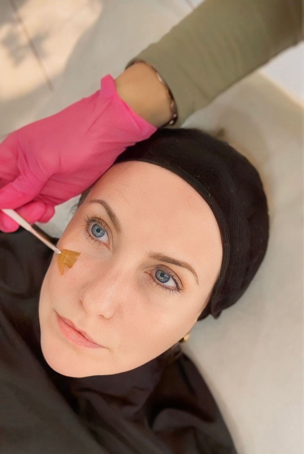 Skin Resurfacing-Chemical Peel