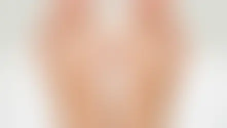 Bunions