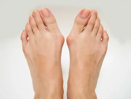 Bunions