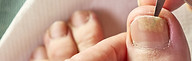 Fungal Nails