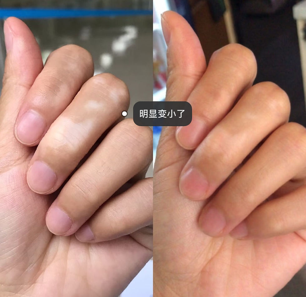 Thumbnail: 白癜風克星POLO DIARY®美國白癜風膏2支