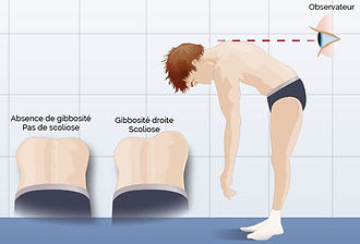 4 Detecter scoliose jeune-compressed.jpg
