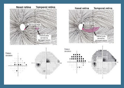 Fibras Nervosas - Glaucoma
