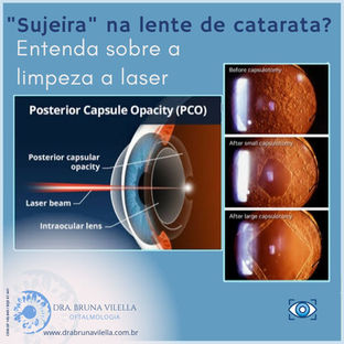 Sujeira na lente de catarata? Entenda como é feita a "limpeza" da lente de catarata.