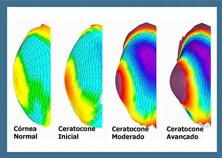 topografia 3D do ceratocone