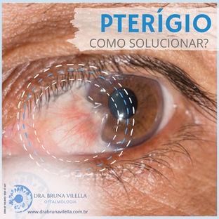 Qual o tratamento do pterígio?
