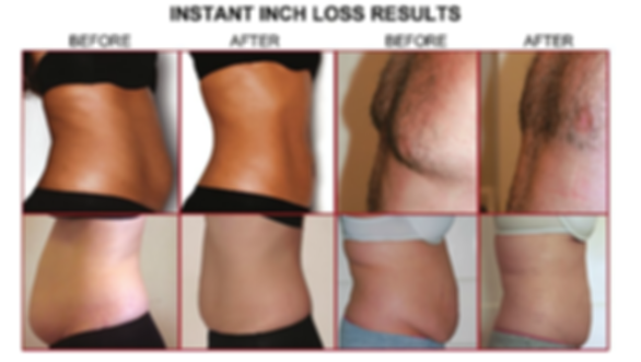 MyLipo Body Sculpting at Fit N Tan