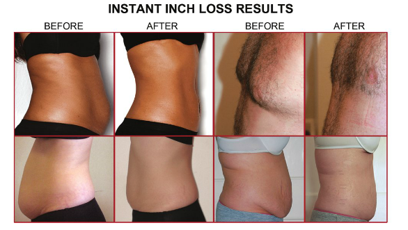 MyLipo Body Sculpting at Fit N Tan