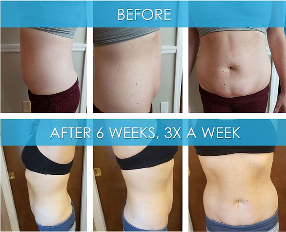 laser lipo, mylipo laser light, laser body sculpting
