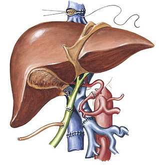 Liver transplant picture.jpg